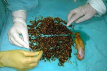 Calcul vesicule biliaire operation Calcul vesicule biliaire operation