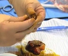 Calcul vesicule biliaire operation Calcul vesicule biliaire operation