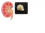 Calcul renal 3